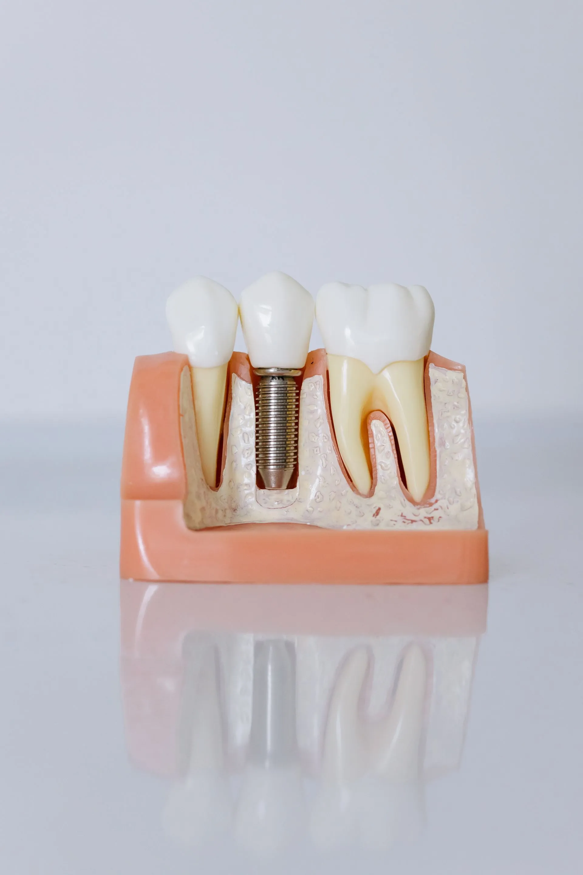 Modelo dental mostrando un implante de titanio junto a los dientes naturales