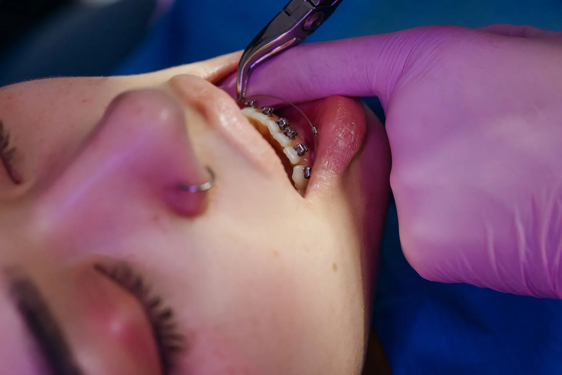 Ajuste de brackets de ortodoncia en un tratamiento dental